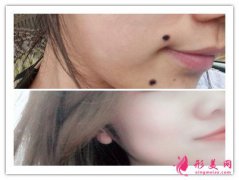 激光點(diǎn)痣有多疼-激光點(diǎn)痣疼嗎？