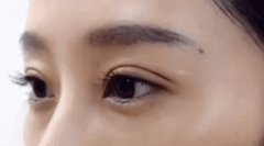 割雙眼皮后睜眼困難怎么辦?
