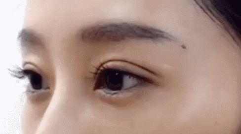 割雙眼皮后睜眼困難怎么辦