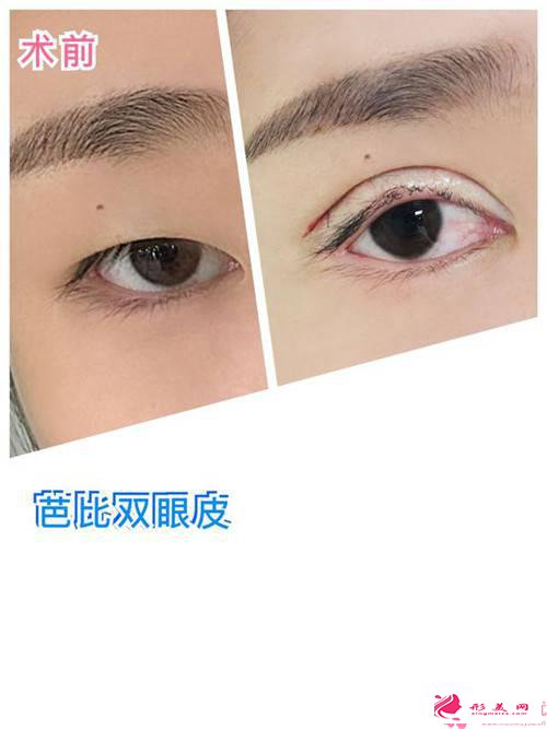 雙眼皮有點(diǎn)寬_雙眼皮不滿意怎么辦