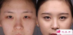 開內(nèi)眼角手術(shù)適合人群_開內(nèi)眼角手術(shù)適合哪些女性？