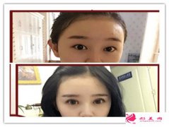 韓式雙眼皮手術(shù)-韓式雙眼皮效果好不好？