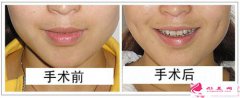 酒窩成形術(shù)-酒窩形成術(shù)安全嗎？
