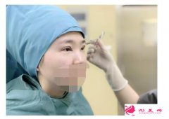 西安割雙眼皮哪家醫(yī)院好？ 推薦這家醫(yī)院給大家