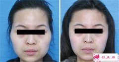 豐太陽穴的危害_豐太陽穴效果怎么樣？