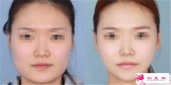 下頜角磨削術(shù)下頜角磨削術(shù)有危險嗎？