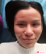 武漢愛思特做下頜角整形的價格是多少？
