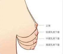 乳房下垂程度了解？
