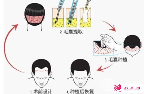 植發(fā)手術(shù)