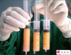 做體雕術術后的效果怎樣?
