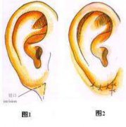 耳部缺陷治療復(fù)原的效用怎么樣？