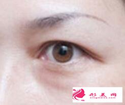 眼袋出現(xiàn)的原因有哪些?怎么祛眼袋
