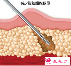 抽脂減肥的大致過程及術(shù)后癥狀