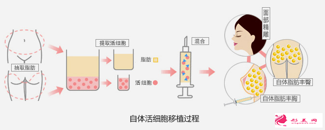 自體脂肪填充面部有硬結怎么辦
