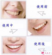 牙齒不齊有哪些危害呢？