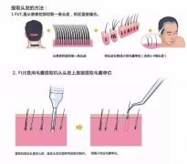毛發(fā)移植美容術(shù)過后生存率是多少？