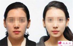注射瘦臉針需要注意些什么？