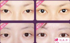 埋線雙眼皮的并發(fā)癥有什么？