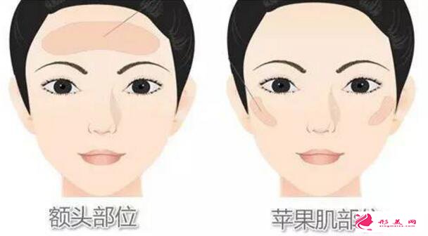 脂肪填充面部的大概過程