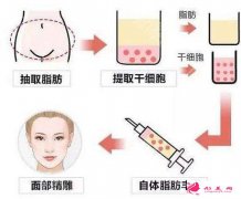 自體脂肪填充面部要注射幾次才有效果？