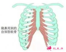 自體軟骨隆鼻的恢復(fù)時間