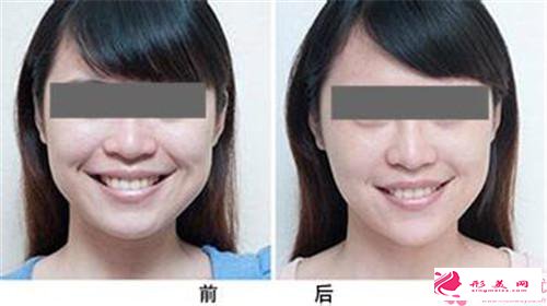 自體脂肪填充面頰的價位_自體脂肪填充面頰要多少價位