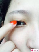 做雙眼皮手術(shù)的費(fèi)用是和哪些因素有關(guān)