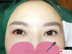 哪些情況不能做韓式雙眼皮