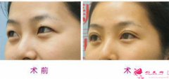 雙眼皮提高的結(jié)果好嗎