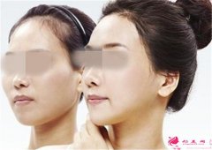 磨骨改臉型手術(shù)會不會損傷神經(jīng)