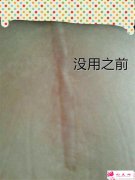 整形術(shù)后會留疤嗎？