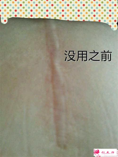 術(shù)后疤痕問(wèn)題_整形術(shù)后會(huì)留疤嗎