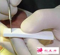 膨體植入鼻部后會產(chǎn)生排斥反應嗎?