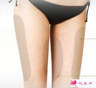 大腿吸脂術(shù)后會出現(xiàn)不均勻的情況嗎