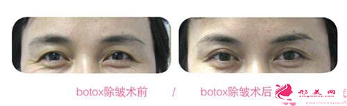 熊貓眼去除的價錢是多少_去除熊貓眼一般需要多少錢