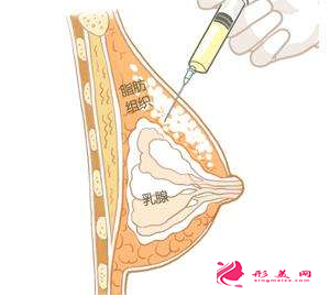 自體脂肪隆胸后能喝酒嗎