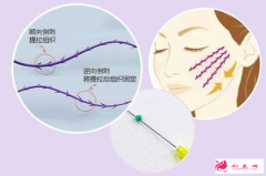 線雕提升適合什么年齡段的人做