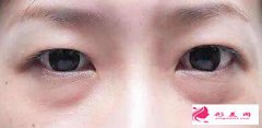 手術切除眼袋安全嗎？