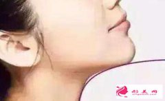 假體墊下巴的風險大不大？