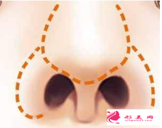 鼻翼縮小手術(shù)常見風(fēng)險有哪些？