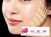 埋線提升能保持多久