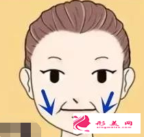 埋線提升要休息多久才能上班