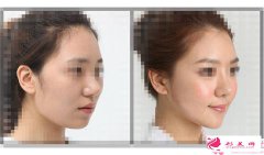 顴骨整形恢復(fù)時(shí)間要多久呢？