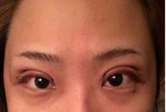 白永輝修復雙眼皮咋樣