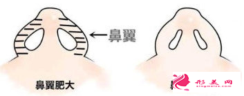 鼻翼縮小手術的疤痕怎么處理