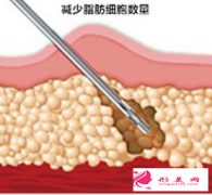 吸脂減肥手術(shù)貴不貴