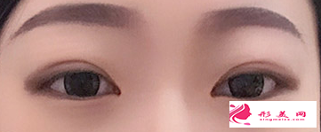 在廣州割雙眼皮要多少錢