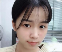成都銅雀臺割雙眼皮哪個醫(yī)生出名?附案例