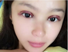 成都劉輔容雙眼皮修復(fù)到底怎么樣？和大家分享一波劉輔容眼修復(fù)案