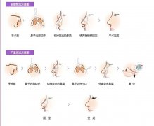 鼻整的效用能持續(xù)多久